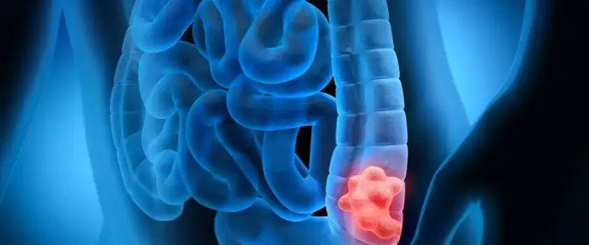 Skąd się biorą gruczolaki? Zaskakujące przyczyny ich powstawania i ryzyka