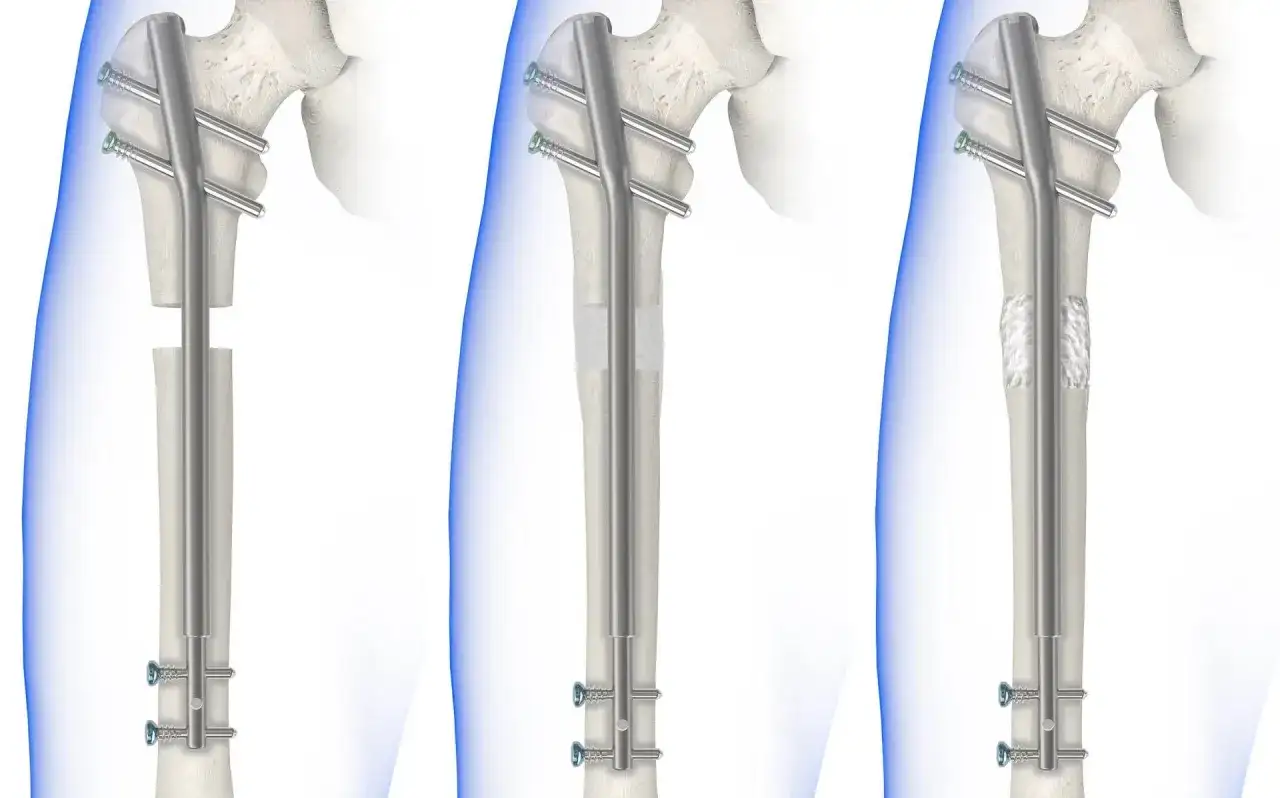Rehabilitacja ud na czym polega: klucz do szybkiego powrotu do zdrowia