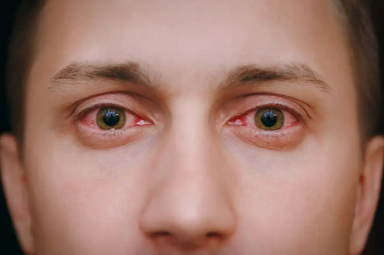 Zaczerwienione oczy przyczyna: poznaj najczęstsze powody i objawy