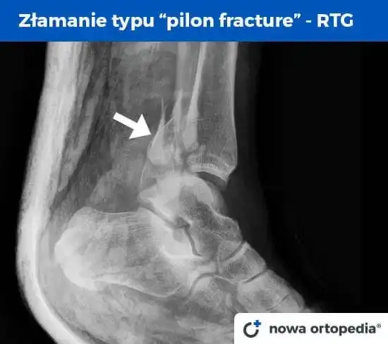 Złamana kostka boczna: Ile trwa leczenie i powrót do sprawności?