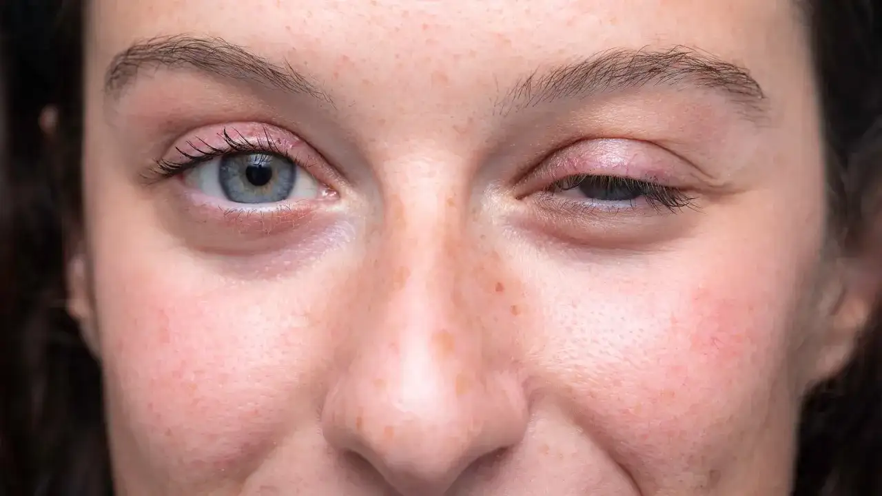 Opadająca powieka przyczyny – zaskakujące powody i skutki problemu