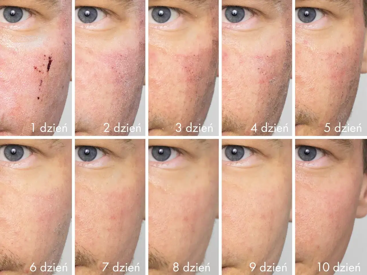 Postęp gojenia się skóry po pryszczu, pokazujący jak szybko pozbyć się strupa. Od dnia 1 do 10 widać redukcję zaczerwienienia i łuszczenia.