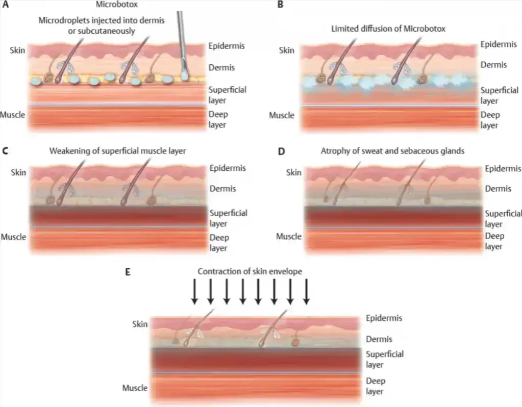 Jak działa botox? Poznaj mechanizm i skutki jego działania