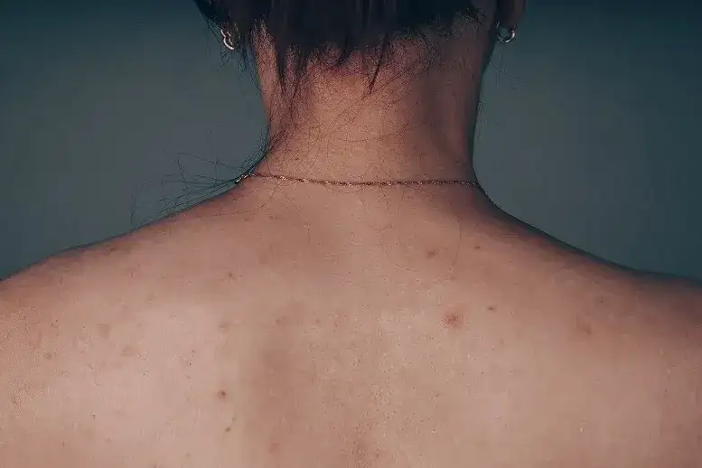 Skuteczne sposoby na bolące pryszcze, które przynoszą ulgę i szybkie gojenie