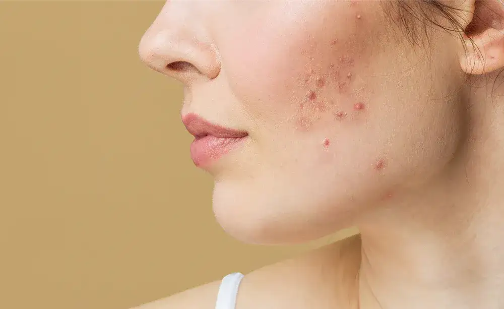 Pryszcze w ciąży: Co bezpieczne? Składniki, których musisz unikać!
