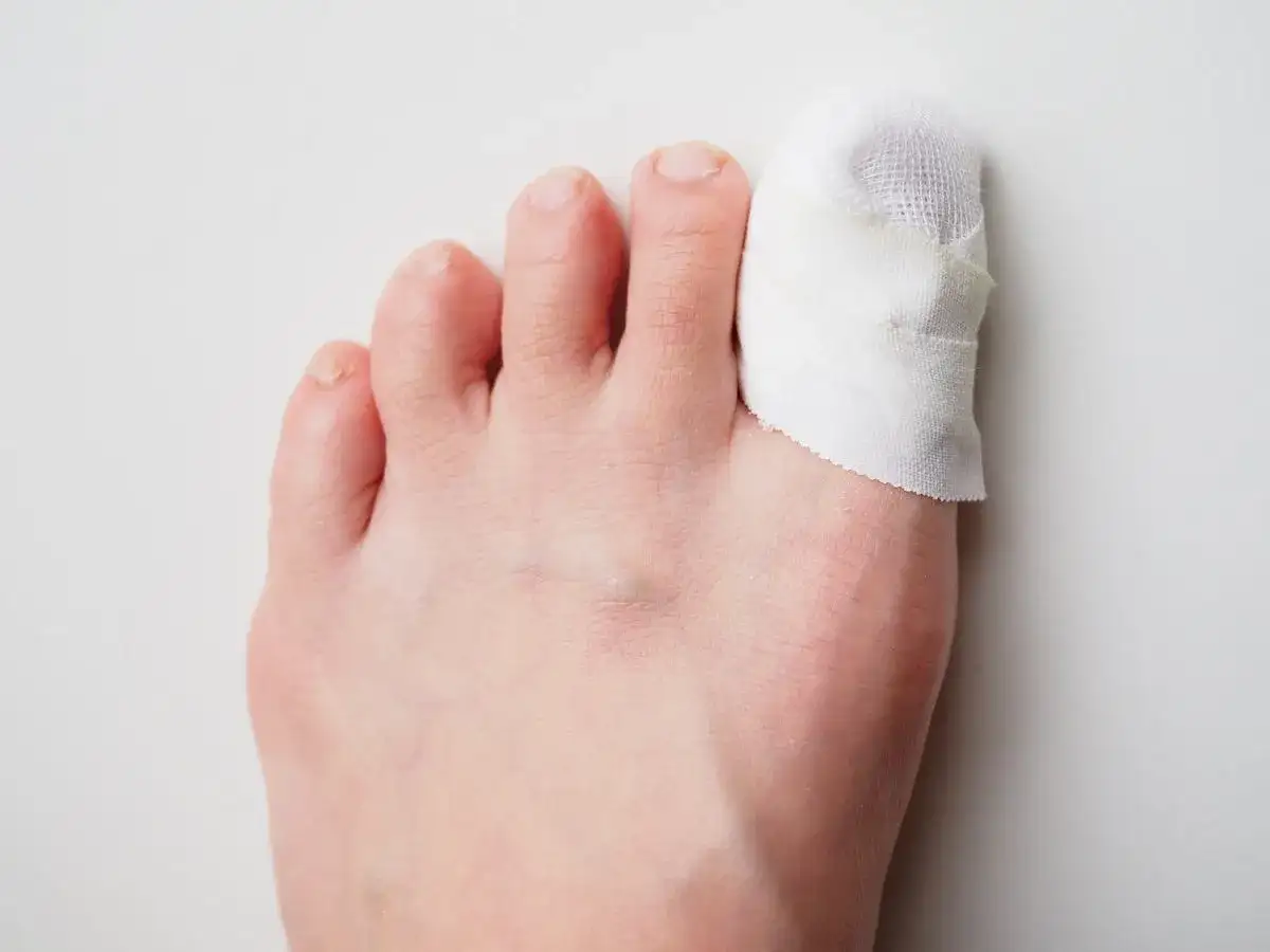 Schodzący paznokieć: Samodzielnie czy do specjalisty? Rozwiewam wątpliwości