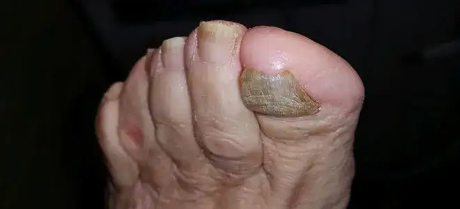 Jak wygląda stopa cukrzycowa? Objawy, zmiany i co powinieneś wiedzieć