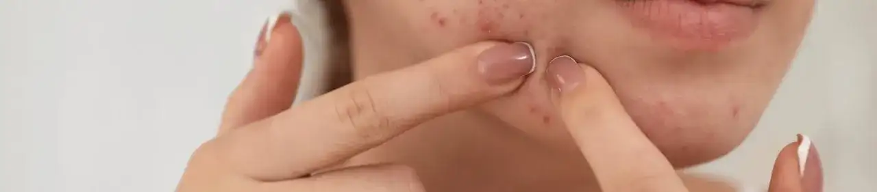 Kiedy wyciskać pryszcze, aby uniknąć blizn i infekcji?