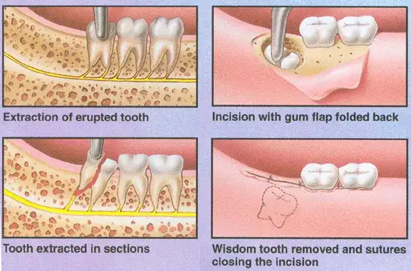 Co dentysta robi z wyrwanym zębem? Szokujące fakty i procedury