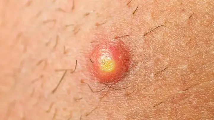 Pryszcze na pośladkach: Przyczyny i skuteczne sposoby na gładką skórę