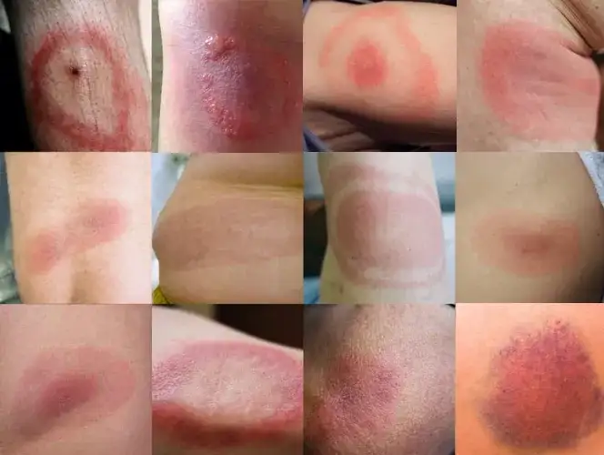 Rumień po kleszczu: Jak wygląda? Jak odróżnić od alergii?