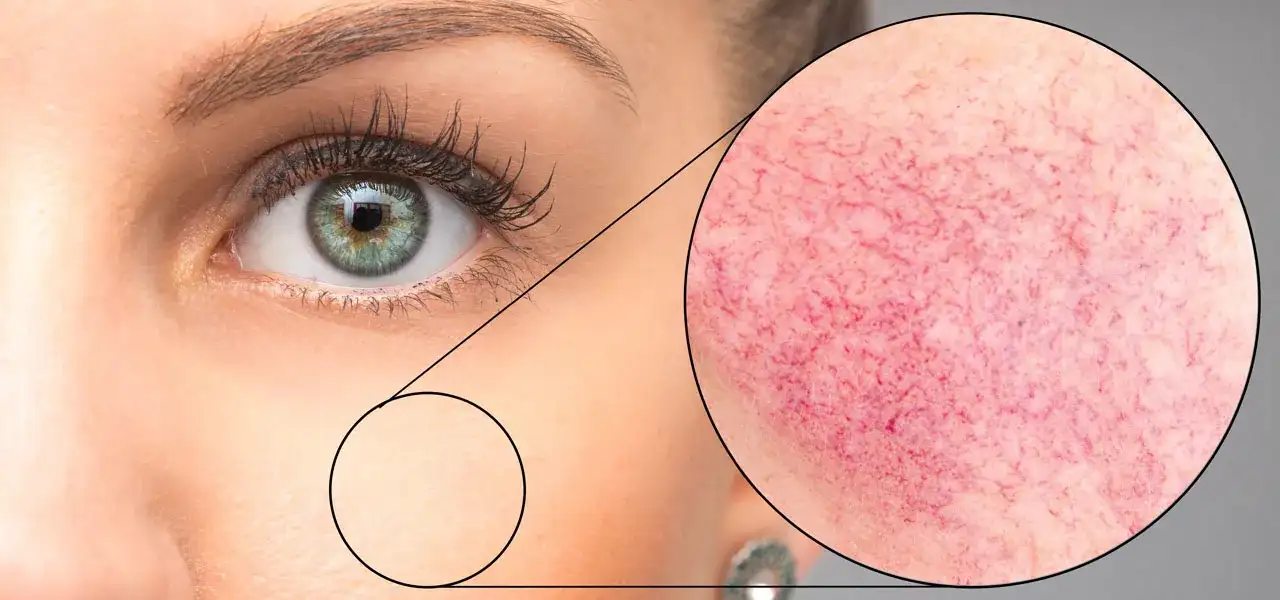 Rumień i pajączki? Jak skutecznie pozbyć się cery naczynkowej