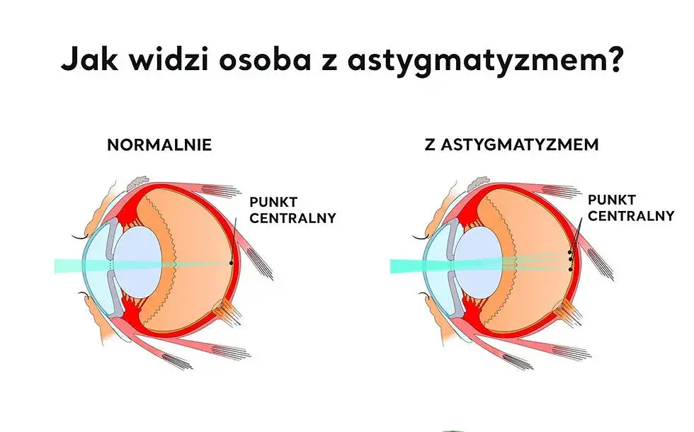 Jakie są wady wzroku? Poznaj objawy i skuteczne leczenie