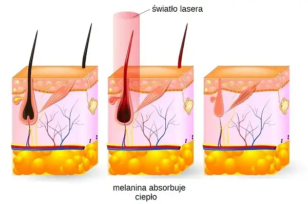 Depilacja laserowa: Jak działa? Laser czy IPL? Wybierz mądrze!