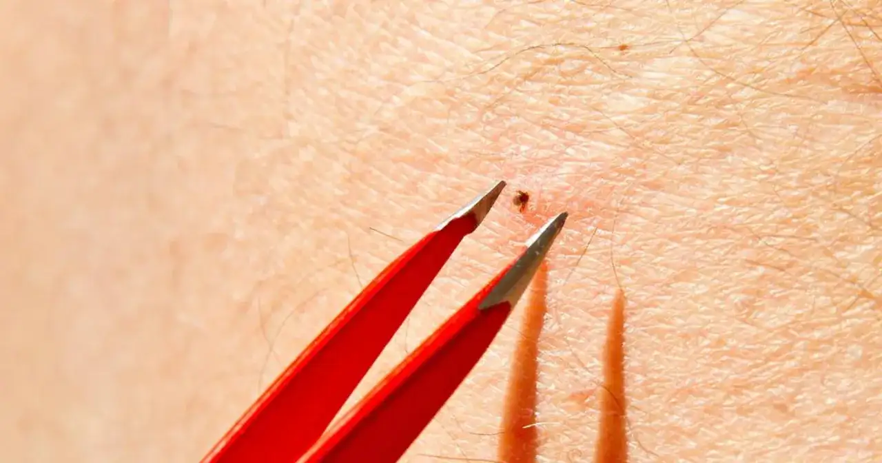 Czerwone pęsety usuwają małego kleszcza w skórze.