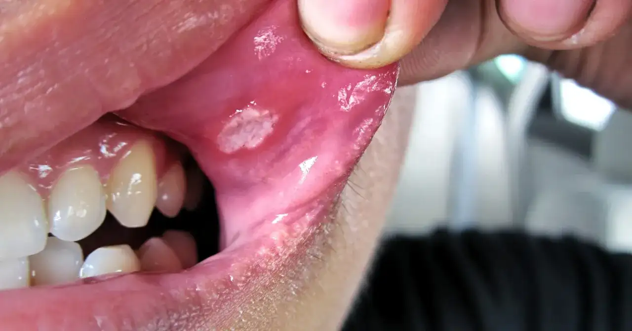 Jak długo trwa afta na dziąśle? Poznaj przyczyny i czas gojenia