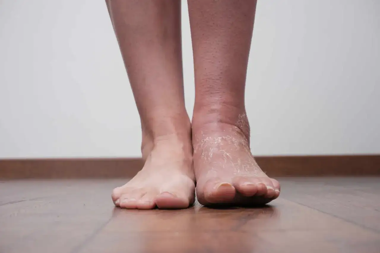 Obrzęk nogi po złamaniu kostki jest widoczny po prawej stronie, gdzie skóra jest spuchnięta i sucha.