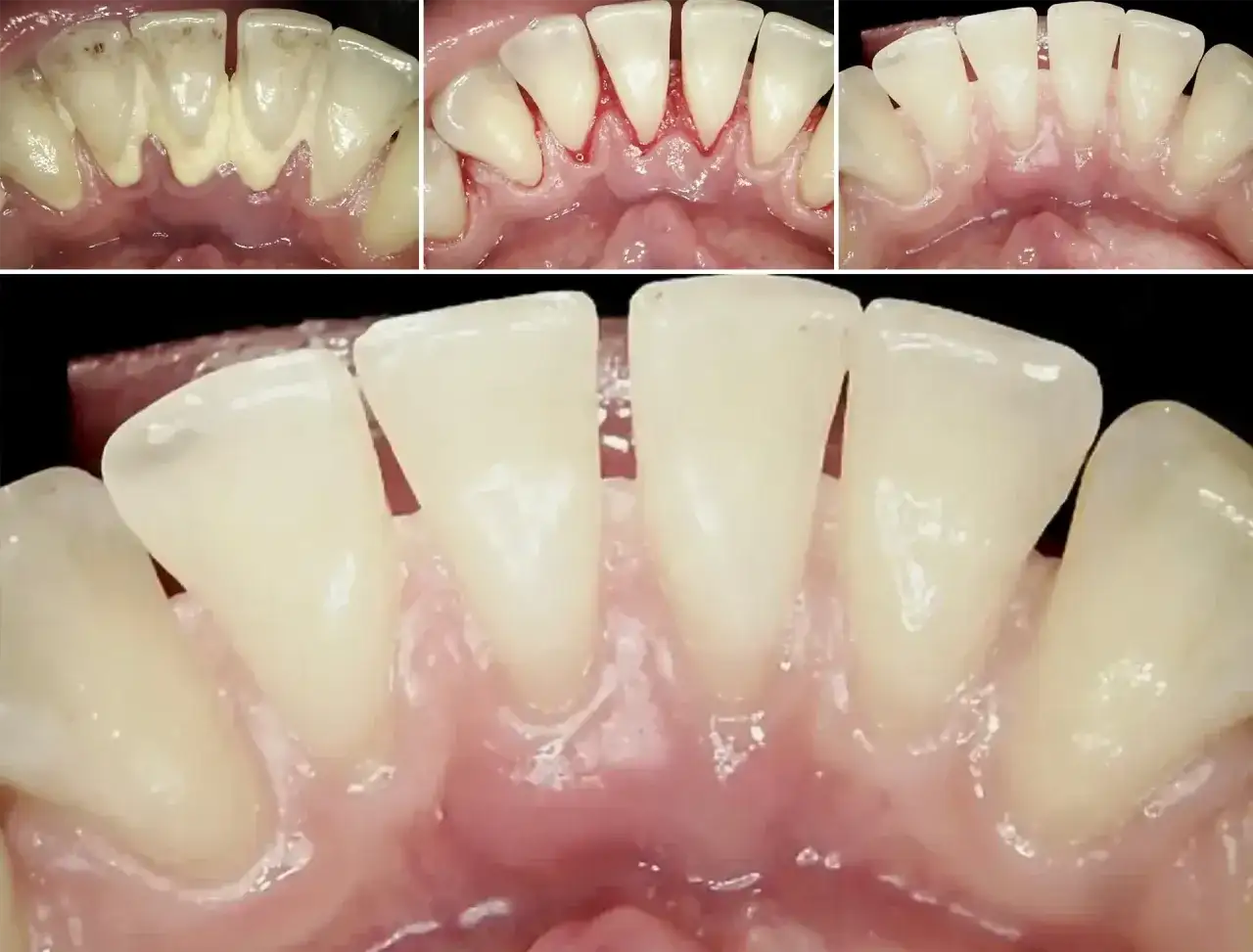 Zapalenie dziąseł: Ile trwa i jak szybko je wyleczyć?