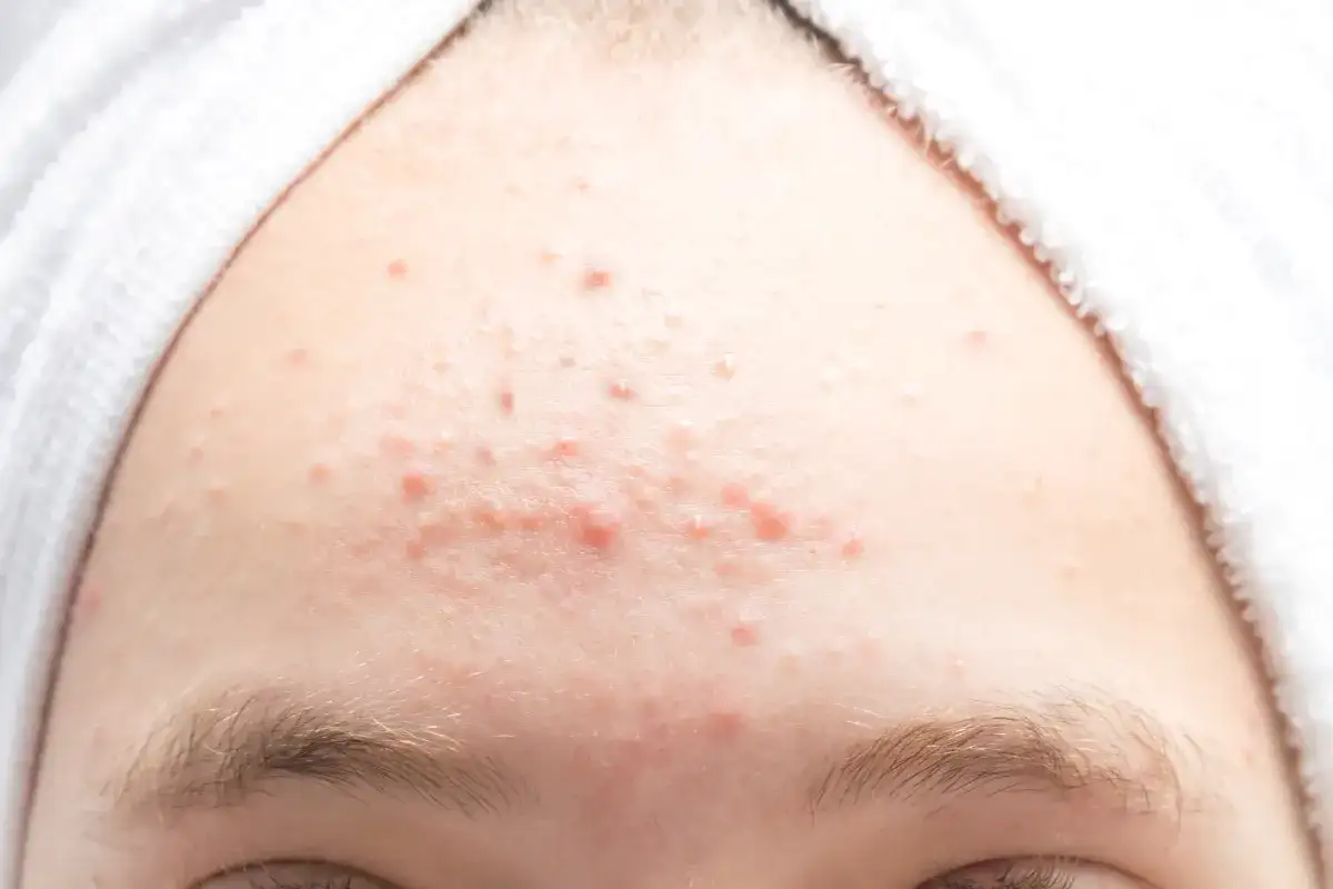 Skóra czoła z licznymi wypryskami. Szukasz sposobu, jak pozbyć się pryszczy na czole?
