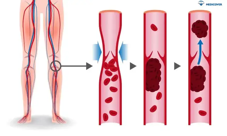 Zakrzepica żył: Leki, leczenie i dlaczego tylko na receptę?