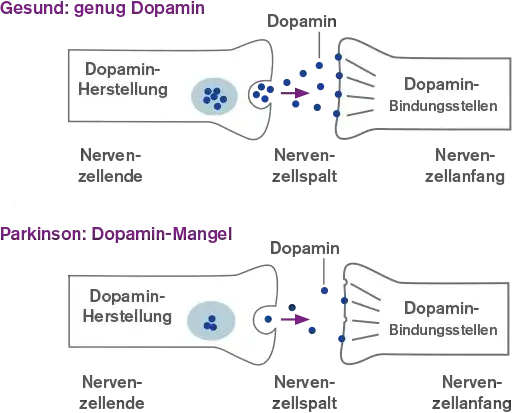 Die entscheidenden Schritte der Parkinson Diagnostik verstehen