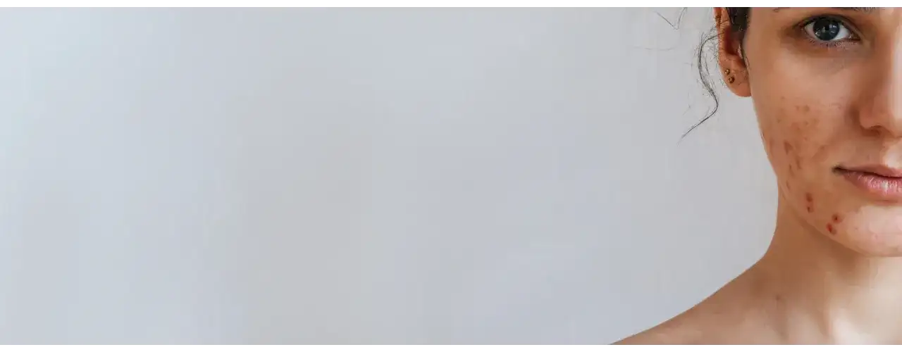 Jaki peeling do cery trądzikowej? Odkryj skuteczne rozwiązania dla skóry