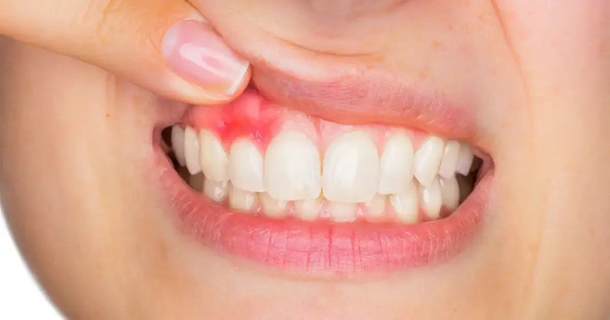 Skuteczne metody leczenia krost w jamie ustnej i ich przyczyny