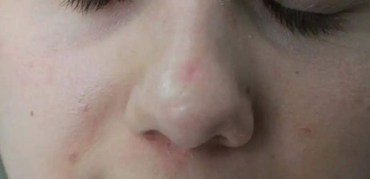 Jak szybko pozbyć się strupa po pryszczu i uniknąć blizn