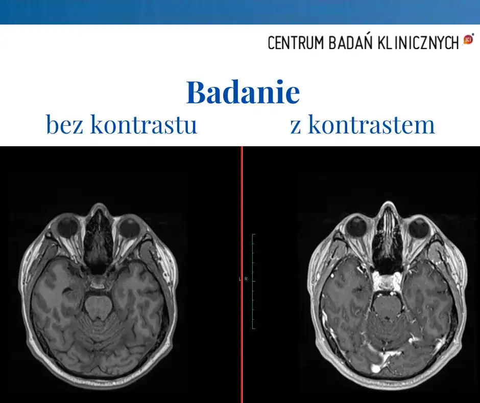 Skutki uboczne po podaniu kontrastu tomografii - co warto wiedzieć?