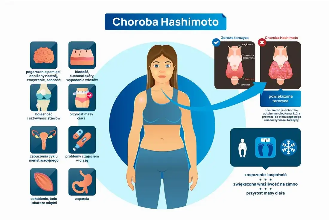 Wszystkie objawy choroby Hashimoto - kompletna lista symptomów