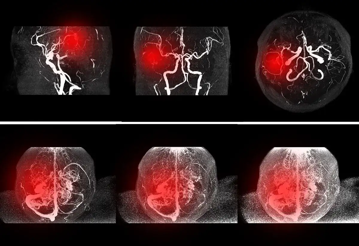 Ból tętnicy szyjnej objawy: co może oznaczać Twój ból?