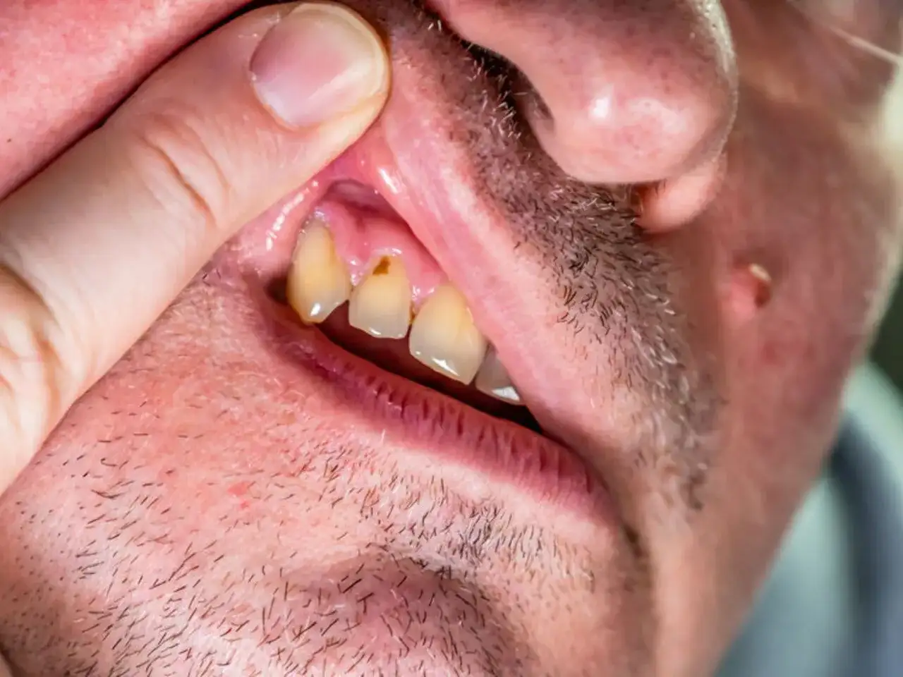 Rana na dziąśle: Jak szybko wyleczyć i kiedy iść do dentysty?