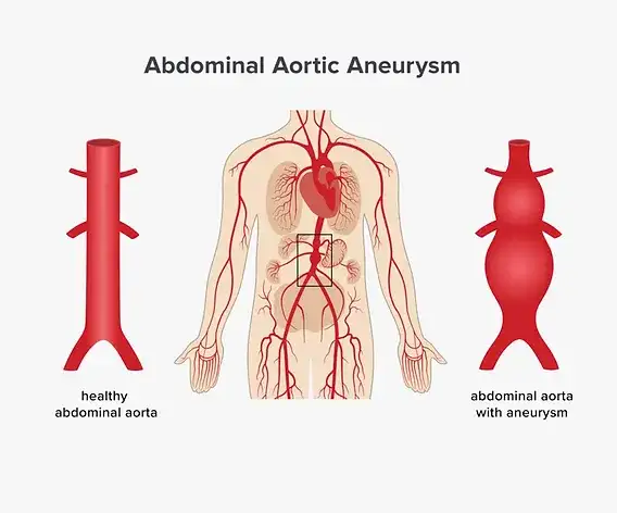 Aneurysma Symptome Bauch: Warnsignale, die Sie nicht ignorieren sollten