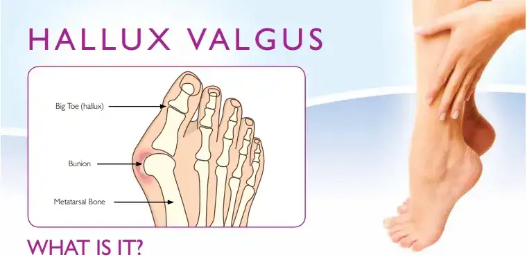 Haluksy: Od czego powstają? Poznaj 7 kluczowych przyczyn!