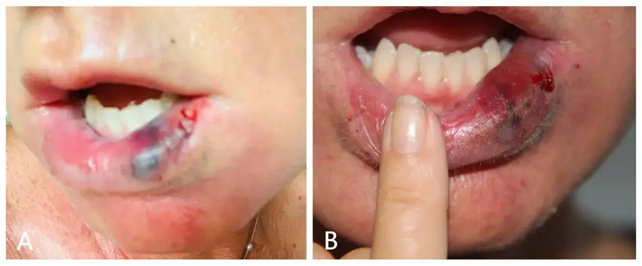Labios deformados por ácido hialurónico: causas, consecuencias y soluciones