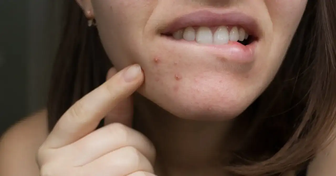 Szybki ratunek na pryszcz: Jak pozbyć się go w jedną noc?