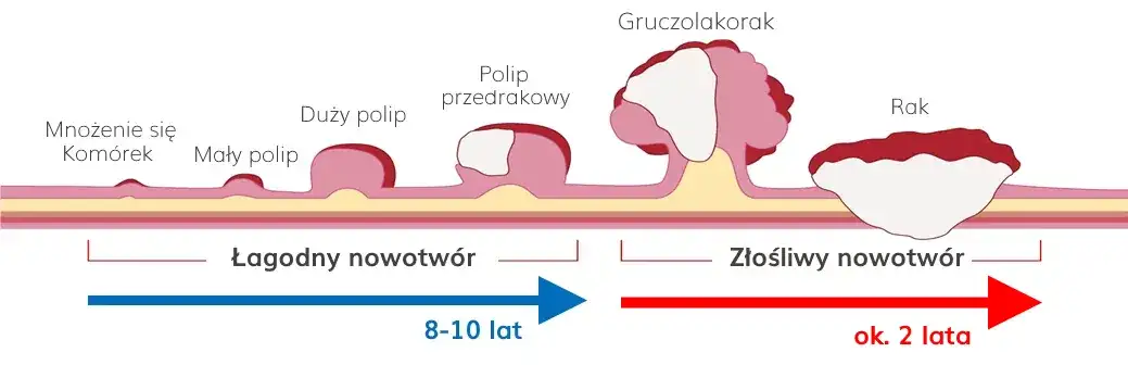 Stolec przy raku jelita grubego: kluczowe zmiany i objawy