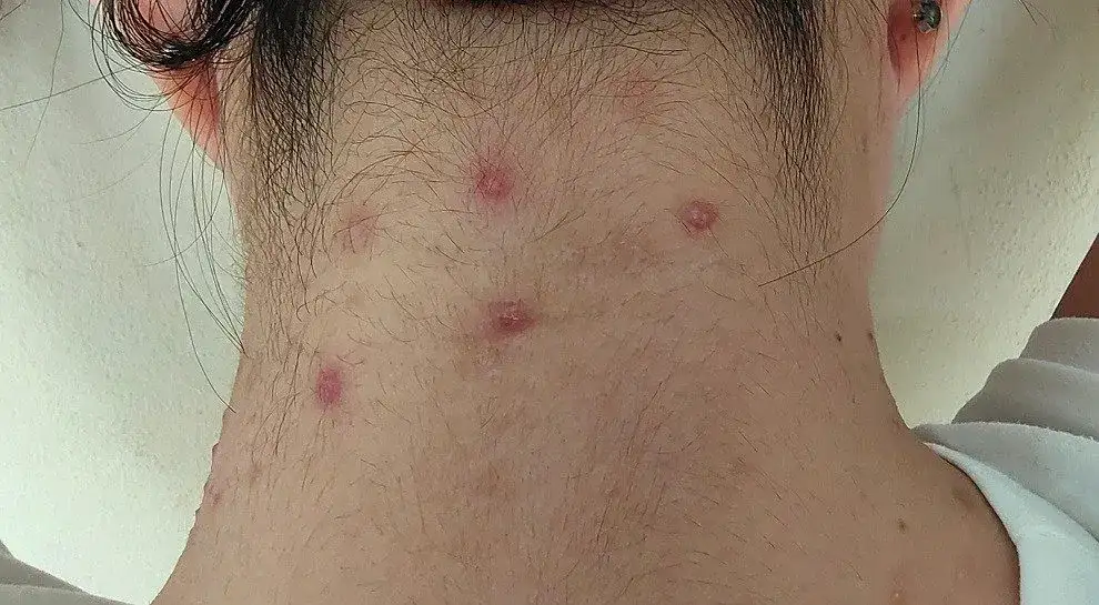 Pryszcze na szyi: przyczyny, leczenie i jak się ich pozbyć