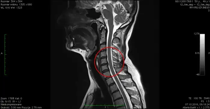 Przepuklina kręgosłupa szyjnego C6-C7: objawy, diagnoza i leczenie