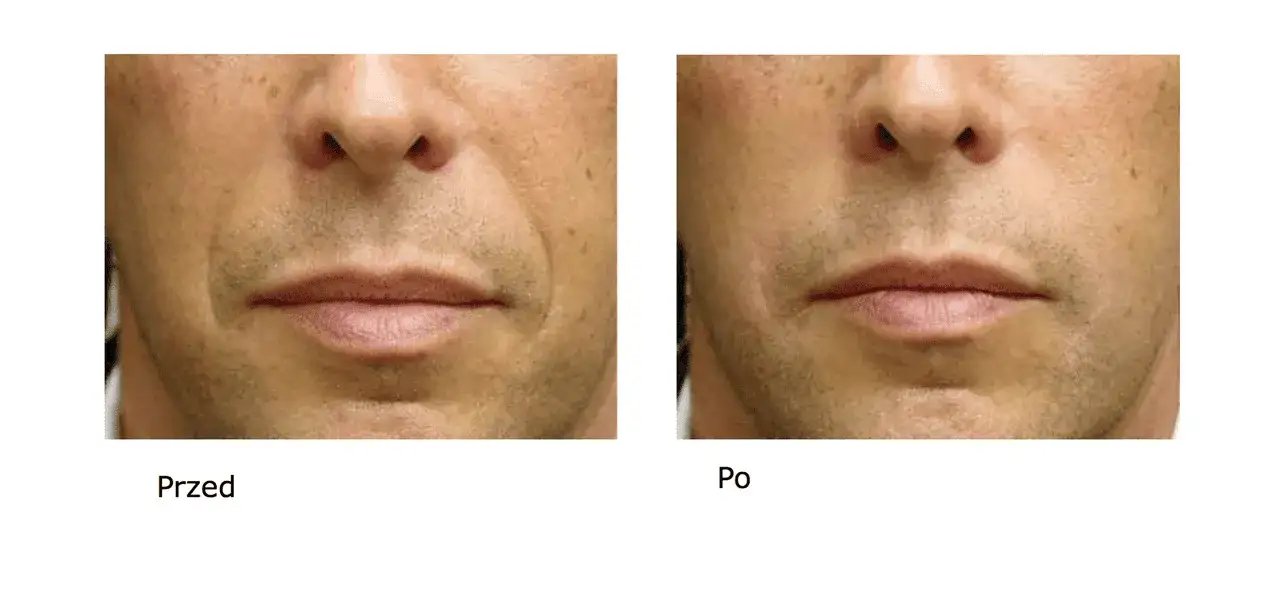 Kwas hialuronowy ile się utrzymuje – jak długo cieszyć się efektami?