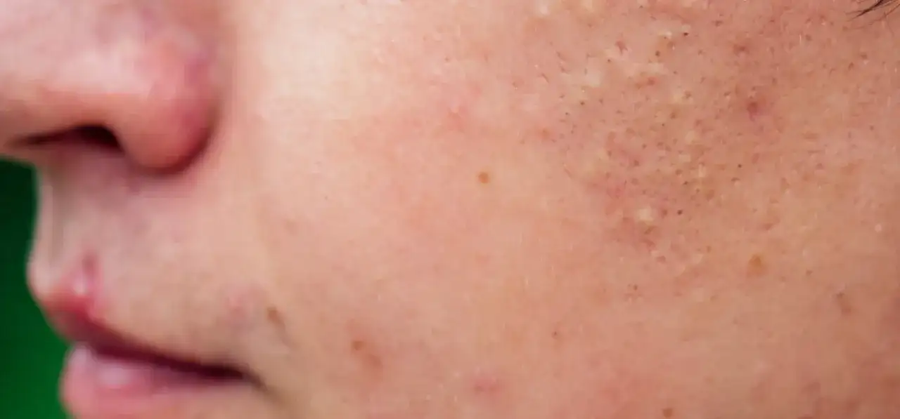 Skąd się biorą pryszcze? Poznaj przyczyny i skuteczne rozwiązania