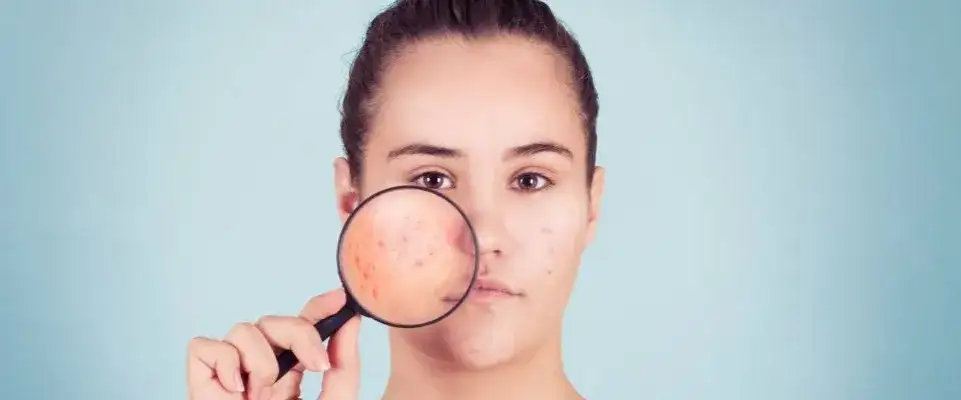 Jak pozbyć się śladów po pryszczach – skuteczne metody i porady