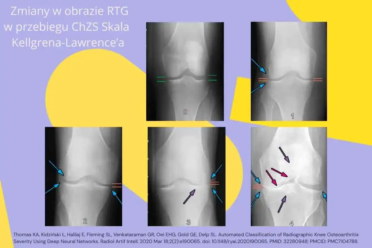 Choroba zwyrodnieniowa: Czy Cartexan to rozwiązanie dla Twoich stawów?