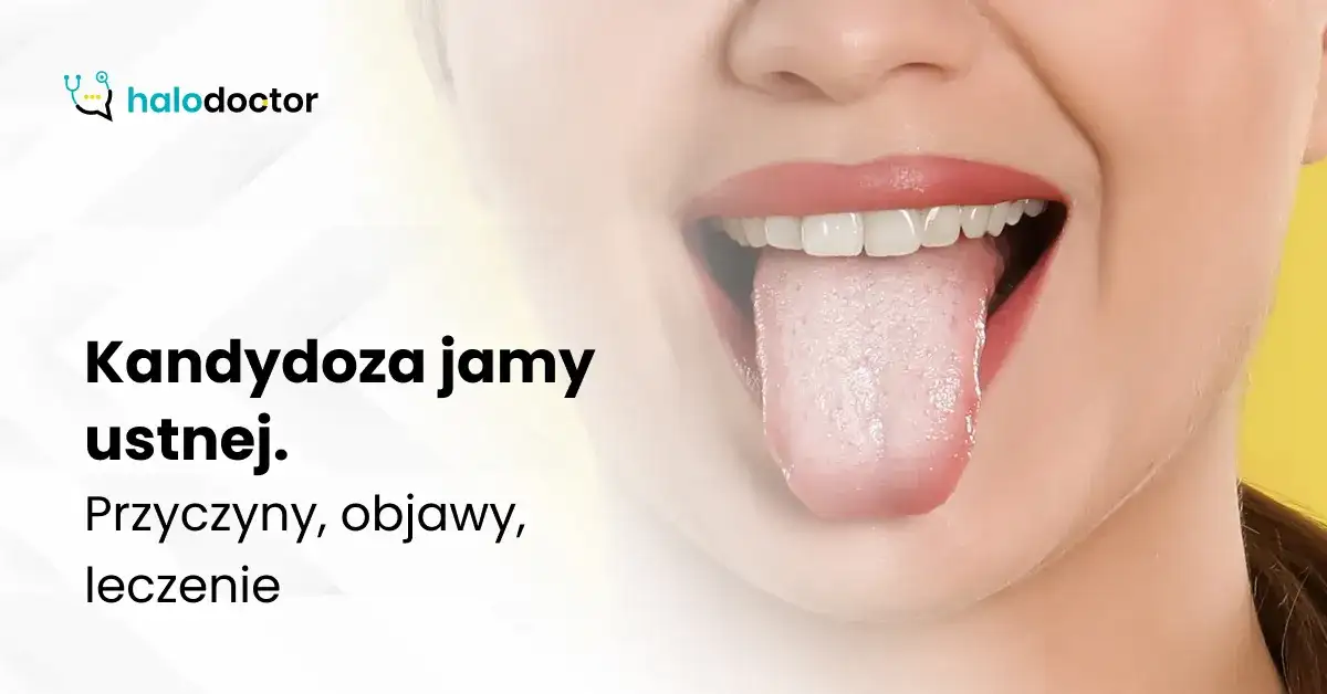 Kandydoza jamy ustnej: objawy, przyczyny i kiedy iść do lekarza