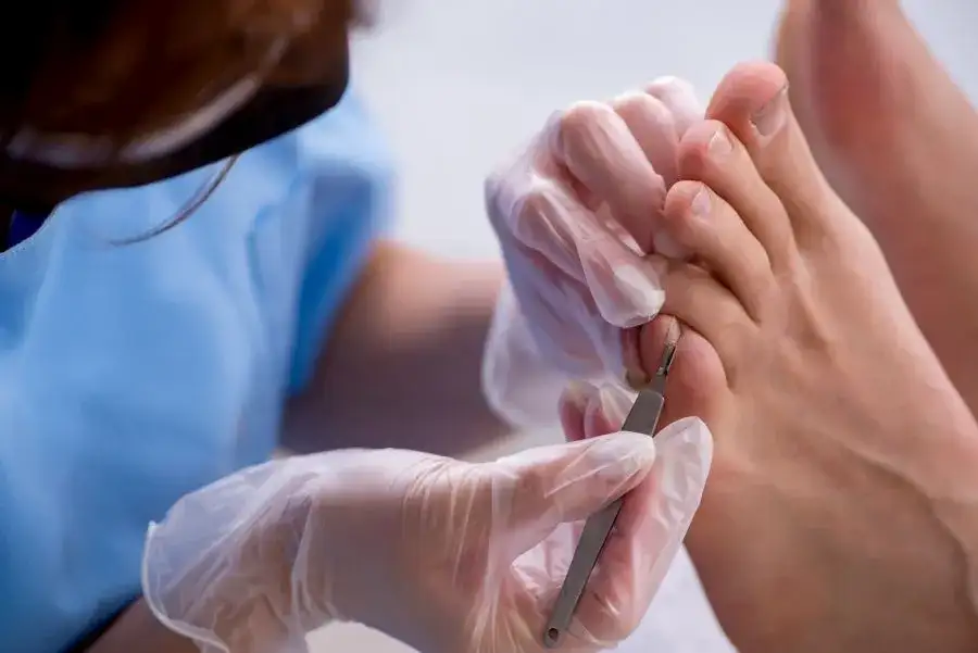 Wrastający paznokieć: domowe sposoby, leczenie i zapobieganie