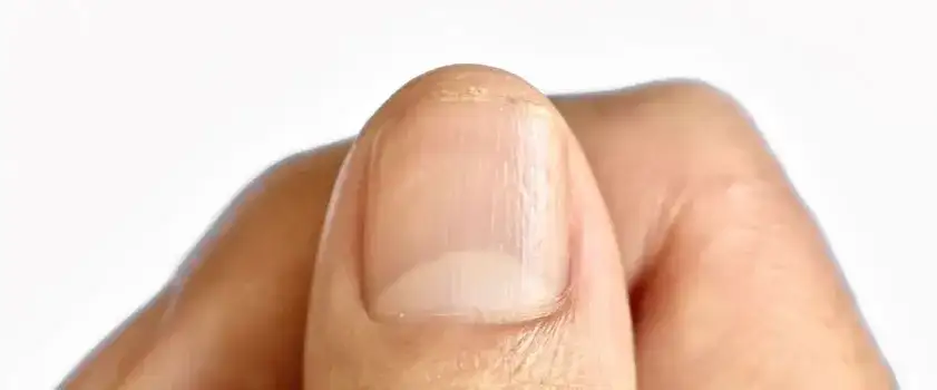 Czy można malować paznokcie z łuszczycą? Kompletny poradnik