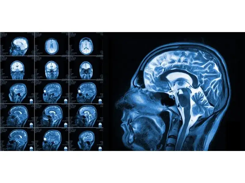 Fizjoterapeuta a rezonans magnetyczny (MRI): kto wystawia skierowanie?