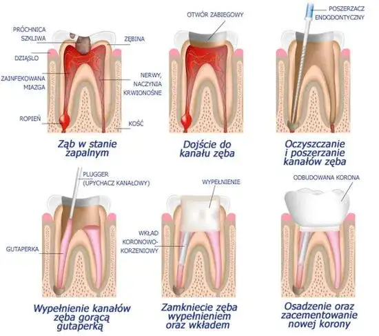 Przepełnienie kanału zęba objawy: jak rozpoznać i uniknąć bólu