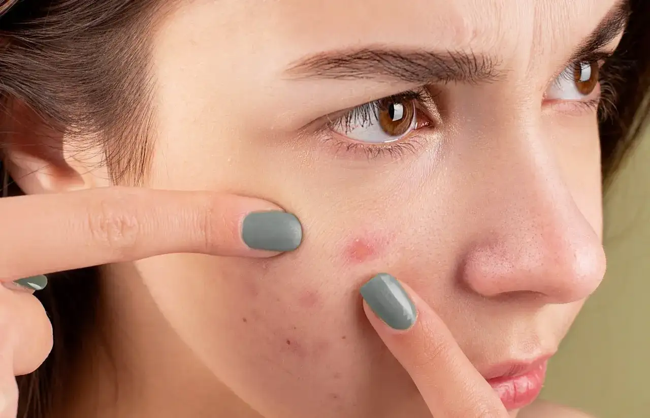 Czy powinno się wyciskać pryszcze? Poznaj ryzyko i skutki tej praktyki