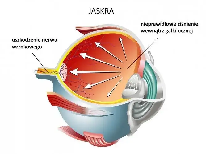 Czy jaskra jest wyleczalna? Odkryj prawdę o leczeniu tej choroby